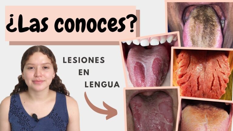 Descubre los diferentes tipos de glositis en la lengua: ¿cuál es el tuyo?